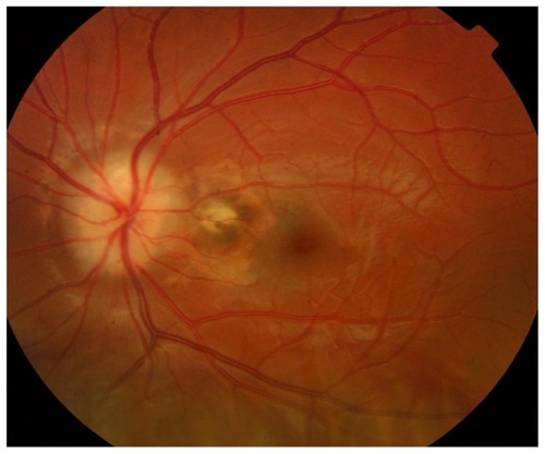 Figure 2 Fibrous choroidal neovascularization in the papillomacular bundle without activity on the left eye.
