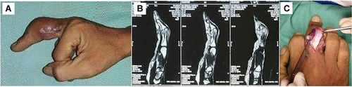 Figure 3 (A) sinus on lateral part of middle phalanx; (B) Tenosynovitys appearance from MRI; (C) Granulation tissue was found below extensor tendon.
