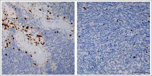 Figure 1. Distribution of tumor infiltrating lymphocytes in pediatric medulloblastoma. Distribution of CD3+ T-cells in pediatric medulloblastoma resembles two distinct patterns i.e. perivascular (left panel) and intratumoral (right panel) that often coincide. Scale bar equals 100 μm.