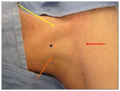 Figure 5 Sedillot’s triangle: sternal head of sternocleidomastoid (yellow arrow), clavicular head sternocleidomastoid (orange arrow), clavicle (red arrow); and position of appropriate cutaneous puncture at apex of triangle (black star).