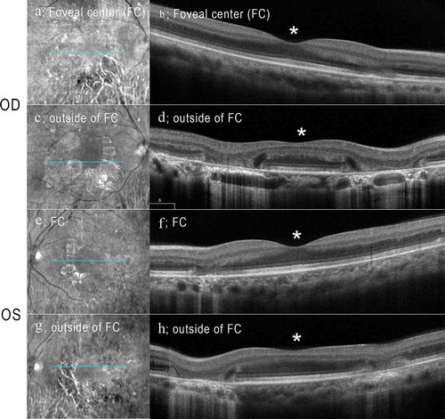 Figure 3. Spectral-domain optical coherence tomographic (SD-OCT) images of the patient with MIDD