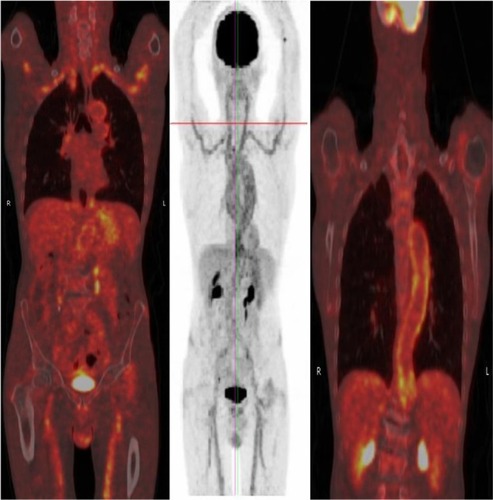 Figure 3 Fluorodeoxyglucose-positron emission tomographic scan showing florid uptake in large vessels including the aorta in a 74-year-old man who presented with polymyalgic symptoms and high inflammatory markers.