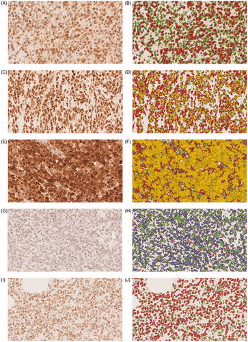 Figure 1. Immunohistochemical staining of formalin-fixed, paraffin-embedded tumor tissues (magnification ×40) with TBLR1 and CREBBP antibodies with corresponding pseudo-colored images from the digital image analyses (blue: negative; green: positive with weak intensity; red: intermediate intensity; yellow: strong intensity). TBLR1: (A, B) low % of strong nuclear staining intensity, equal amounts of weak and intermediate intensity, (C, D) higher % of strong staining intensity with lower % of weak intensity and with intermediate intensity the same as A and B, (E, F) very high % of strong nuclear staining intensity and low % of intermediate and weak intensity. CREBBP: (G, H) low % of nuclei with intermediate/strong nuclei staining intensity, and (I, J) high % of intermediate/strong nuclear staining intensity.