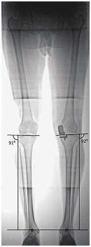 Figure 1. Measurement of knee joint line obliquity (KJLO) in the operated lower limb and in the unaffected contralateral lower limb on a postoperative full-length, standing hip-to-ankle radiograph.