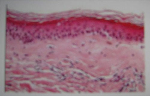 Figure 5 Patch biopsy of the involved area with findings of chronic inflammatory disease evidenced as panniculitis and chronic radiodermatitis.
