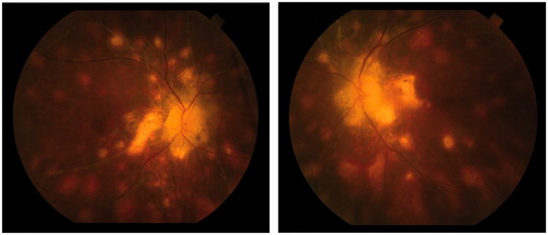 Figure 1. Both fundi showing classic end stage birdshot picture; profound optic atrophy surrounded by large patches of atrophic retina, multiple deep oval lesions extending to the midperiphery and involving the macula. There is profound arteriolar attenuation and mild inactive-appearing venous sheathing. There are also multiple punched out lesions.