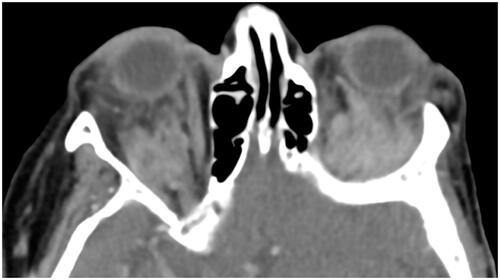 Figure 3 Bilateral infiltration of the orbital fat pad in a patient with OAL (axial CT scan with contrast agent, soft tissue window).