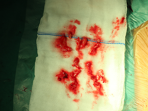 Figure 3 The inflammatory tissue of the spinal canal that was surgically removed in triple group.
