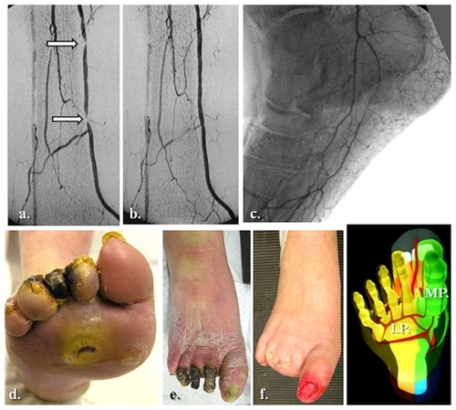 Figure 6 Global medial and lateral plantar artery critical ischemia and acute diabetic foot syndrome matching staged occlusions in the posterior tibial artery (with end-artery occlusive disease model to the sole). (a) Prime posterior tibial artery staged subocclusive lesions. (b) and (c) The reestablished flow in the posterior tibial and both right plantar arteries. (d) The initial clinical aspect. (e) Subsequent evolution at 3 weeks. (f) Clinical results after 5 months of team surveillance.