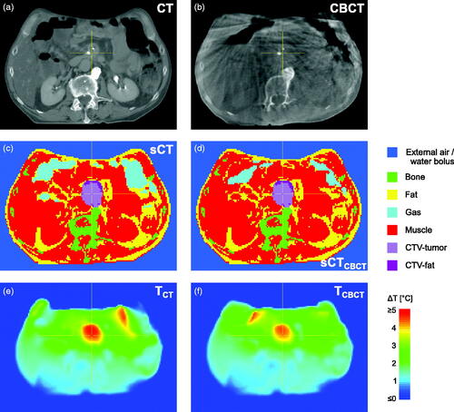 Figure 2. Example of imaging data and calculation results for patient P7, with (a) CT scan, (b) CBCT of 5th fraction, (c) segmented CT (sCT), (d) sCTCBCT, i.e. sCT with GG-CT replaced by muscle and GG-CBCT inserted, (e) temperature distribution for sCT, (f) temperature distribution for sCTCBCT. GG volume was 699 cm3 for sCT (c) and 260 cm3 for the sCTCBCT (d). Note: for calculations, segmented external air was replaced by water bolus.