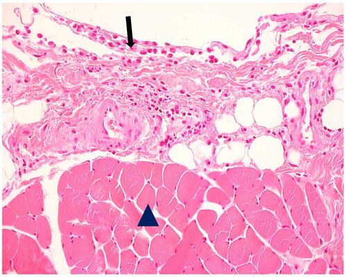 Figure 2 Muscle biopsy shows focal infiltration of the epimysium by large mononuclear cells of the monocyte and macrophage lineage (arrow), admixed with a small number of lymphocytes. Note that the muscle fibers remote from the inflammatory infiltrate are intact (arrowhead) (H&E×100).