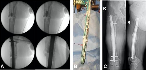 Figure 2 Implant coating of a nail. (A) filling up the intramedullary canal with Cerament V and implantation of the augmented nail; (B) coating of the nail before implantation; (C) x-ray 22 moths after implant coating.