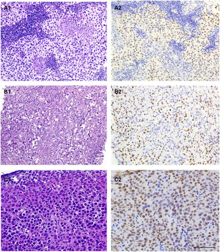 Figure 5 Extragonadal germinomas involving the sellar (A1), mediastinal (B1), and right cervical (C1) regions were obtained through core biopsies. The morphologic features are identical to the testicular or ovarian counterpart; crush artifact and fibrous changes (B1) are not uncommon. All of these tumors express TdT (A2–C2) (amplification: 10×20, bar=50μm).