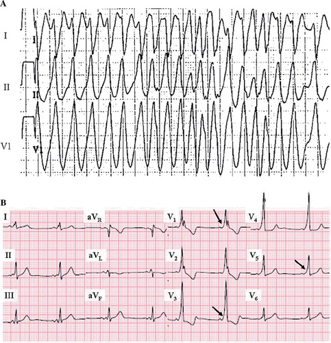 Figure 5. Wolff–Parkinson–White syndrome. A: Rapid conduction through an antero-septal accessory pathway during atrial fibrillation in WPW syndrome, mimicking the appearance of ventricular tachycardia. The irregular ventricular response pattern suggests atrial fibrillation. B: Delta waves indicated with arrows. ECG from different patient than in A. Paper speed 25 mm/s, gain 10 mm/mV.