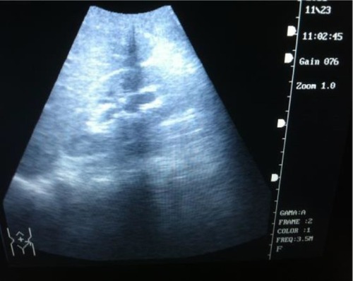 Figure 2 Mild hydronephrosis of left kidney on ultrasound.