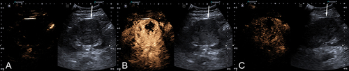 Figure 1 A female patient with renal clear cell carcinoma (arrows) under CEUS (dual layout). (A) Fast-in at 7th sec. (B) Heterogeneous hyperenhancement at 20th sec. (C) Slow-out at 124th sec.