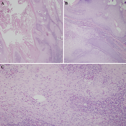 Figure 2 Histopathological Findings. (A) The epidermal depression expanded like a volcanic crater filled with keratinocytes and keratin (HE×40). (B) Squamous epithelial nests infiltrated into the deep irregularly with smooth contours. The top of the deep epithelial nests had increased keratinized beads. The keratinocytes had rich cytoplasm and were eosinophilic (HE×100). (C) A large number of inflammatory cells infiltrated the superficial dermis. Some epithelial cells were atypical. The adjacent epidermis formed an exogenic protrusion, creating a lip-like contour (HE×200).