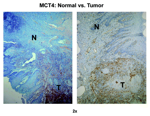Figure 11. MCT4 immunostaining distinguishes tumor tissue from normal adjacent tissue. Note that MCT4 preferentially stains cancer-associated fibroblasts (CAFs) and not normal fibroblasts (NFs), allowing one to distinguish tumor tissue from normal tissue, even at low-magnification. Original magnification: 2×, as indicated. N, normal tissue; T, tumor tissue.