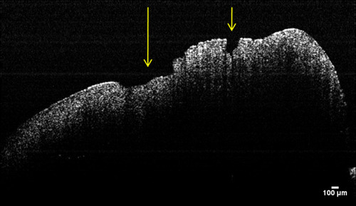 Figure 2 OCT cross-sectional image of gingival tissue from patient with periodontitis and NAFLD. Ulcerative lesions of the gingival epithelium (see arrows).