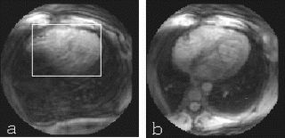 Figure 1. Transaxial slice through the left ventricle before and after localized B0 correction and shim. The images were acquired on a 1.5T GE Signa scanner. The sequence was run with a 28 ms TR, 60° flip angle, 4 spiral arms with 2048 points each and a 24 cm field of view for an effective resolution of 3 mm. Image (a) was acquired at a location where the original shim was no longer optimal. Image (b) was acquired at the same location after applying the shim corrections calculated over the area shown in white.