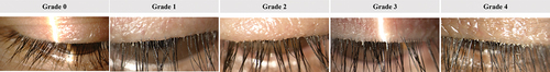 Figure 1. Grading scale (non-linear) used for collarette grading in each eyelid. Grade 0: 0–2 lashes/eyelid with collarettes; Grade 1: 3–10 lashes/eyelid with collarettes; Grade 2: >10 to <1/3 lashes/eyelid (~50 for an upper eyelid with 150 eyelashes) with collarettes; Grade 3: ≥1/3 to <2/3 lashes/eyelid (~100 for an upper eyelid with 150 eyelashes) with collarettes; Grade 4: ≥ 2/3 lashes/eyelid with collarettes. The number of eyelashes on the upper eyelid may vary from 90 to 160.