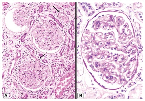 Figure 1 (A) Ischemic changes in the upper glomeruli (arrow). Marked subintimal fibromucoid edema narrowing the lumen in the intralobular arterioles (arrows) and (B) duplication of glomerular basement membrane.