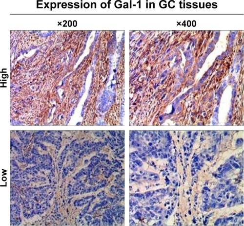 Figure 1 Immunohistochemical staining of Gal-1 expression in GC tissues.