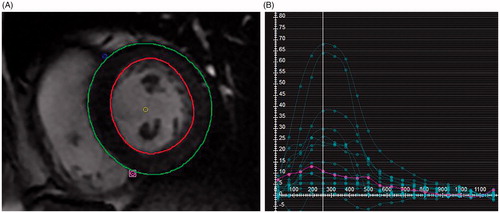 Figure 1. Radial Strain Calculation MRI Feature Tracking (FT) Strain Measurement. (A) On b-SSFP images, the left ventricular epicardial and endocardial contours are manually traced, with exclusion of the papillary muscles. After tracing multiple short axis levels at diastole, MRI FT software generates multiple regional strain curves shown in (B). The y-axis indicates the unitless strain values and the x-axis measures milliseconds after the R wave. From these regional strains a global radial strain is calculated.