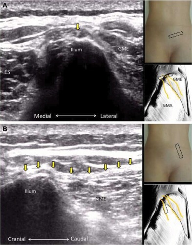 Figure 10 The short axis (A) and long axis (B) views of the superior cluneal nerve.