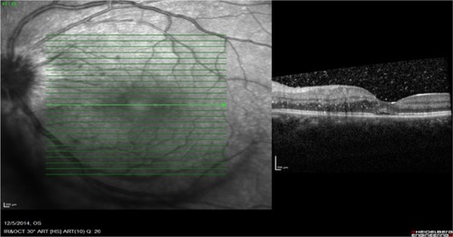 Figure 2 Optical coherence tomography of the left eye showed minimal subretinal fluid at the macula with some hyperreflectivity lesions at presentation. The scale represents the corresponding measurement of 200 mm vertically and horizontally.