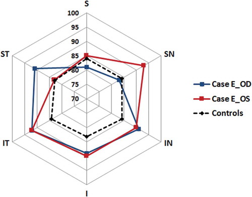 Figure 2. The GCL+IPL distribution in Case E with visual field defects and GCL+IPL thickness values within the normal range but abnormal asymmetry. S = superior, SN = superior nasal, IN = inferior nasal, I = inferior, IT = inferio-temporal and ST = superior temporal GCL+IPL layer sector. The GCL+IPL thickness is indicated on the cardinal positions between the centre point and S. Note that the controls have a symmetric distribution while Case E shows generally high thickness values with a local depression in the SN sector in the right eye (blue line, Case E_OD) and in the ST in left eye (red line, Case E_OS). This relative thinning corresponded with the visual field defects (homonymous defects in the left infero-nasal and right infero-temporal quadrant). No such asymmetry was seen in any of the controls.