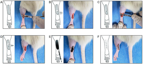 Figure 1 Schematic of the Achilles tendon laceration repair. (A) A incision was made longitudinally along the Achilles tendon. (B) After excising the accessory tendon, the Achilles tendon was transected completely at 5 mm proximal to its insertion into the calcaneus of the foot. (C) The injured tendon was sutured. (D) A second transection was made in the tendon 3 mm proximal to the suturing site to reduce tensile forces across the repair site. (E) Before the skin was closed, 50 µL of the PDA NPs solution (10 mg/mL) was administrated around the suturing site in the photothermal group and the PDA NPs group, whereas 50 µL of PBS was used in the control group. (F) The skin was then closed.