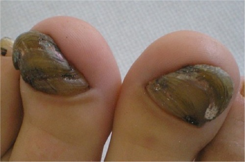 Figure 3 Onychomycosis, onychogryphosis, and choloronychia in a 56-year-old man.