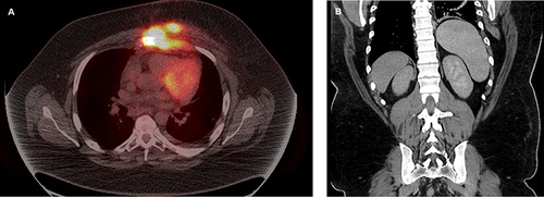 Figure 1 (A) Pre-treatment PET-CT. (B) Post-cycle 1 CT abdomen showing splenomegaly.