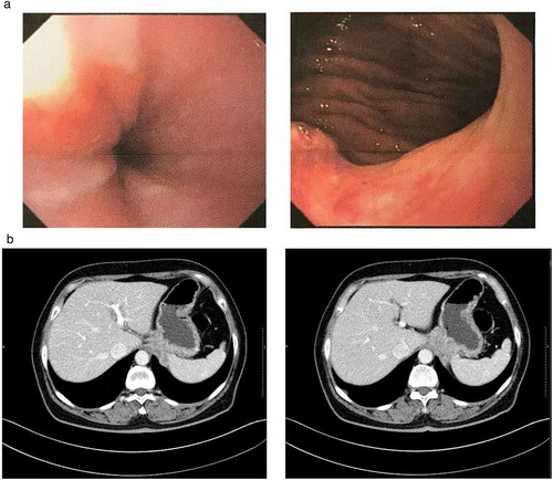 Figure 1. Endoscopy and CT scan. (a) Endoscopy feature capture showing the protruding lesion on the posterior wall of the gastric cardia, with an ulcer in the middle. (b) CT scan showing a non-homogeneously enhanced irregular mass in the gastric cardia, with suspected invasion to the spleen.