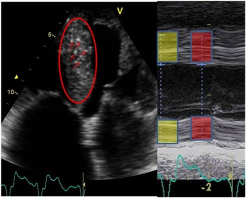 Figure 3 Typical patterns found in echocardiographic examinations in transthyretin amyloidosis patients.