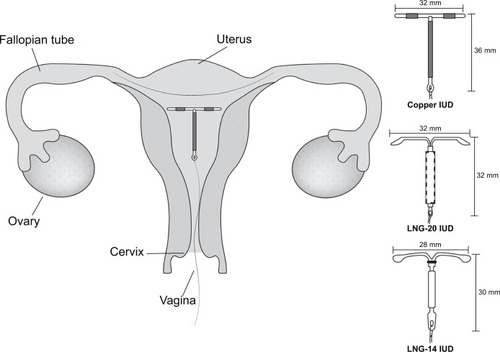 Figure 1 Dimensions and placement of intrauterine devices.