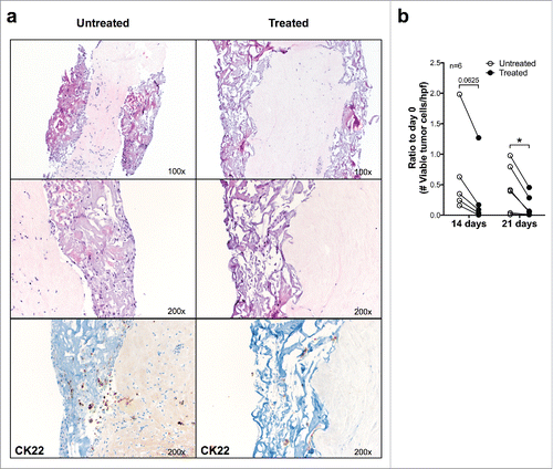 Figure 4. Effects of anti-estrogen treatment on ER+ breast cancer fragments cultured in perfused bioreactors. (A) Fragments from a representative ER+ surgically excised breast cancer were cultured for 21 d in the presence or absence of Fulvestrant (100 nM). Samples were then fixed and paraffin embedded, sections were stained with HE (upper 2 and central 2 panels, magnification 100× and 200×, respectively) or immunohistochemically stained by using a CK22 specific reagent (lower two panels) (Magnification 200×). (B) Cumulative analysis of vtc per high-power field in fragments from six different ER+ breast cancers following culture in perfused conditions in the presence or absence of Fulvestrant. Data represented as ratio compared with day 0 (*p ≤ 0.05).