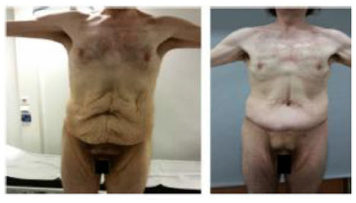 Figure 4 Abdominoplasty.