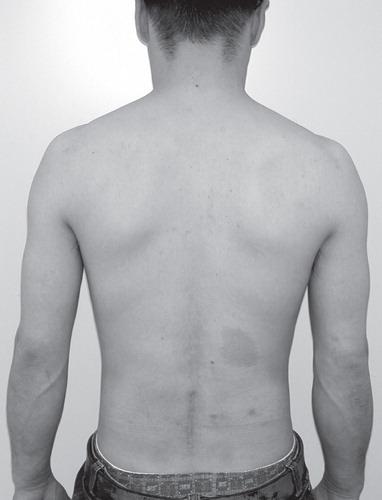 Figure 5. Postoperative clinical photography revealed improvement of scoliosis.