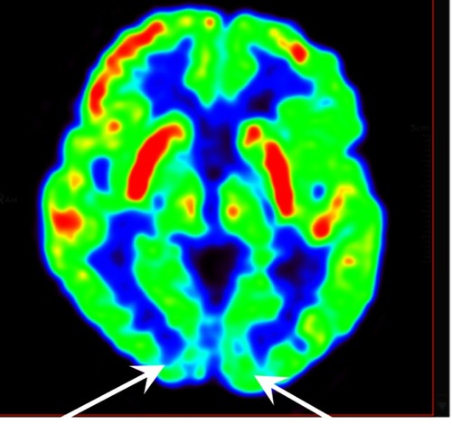 Figure 7 PET-CT image of Hoehn–Yahr stage 3 patient with freezing of gait. Two white arrows show hypometabolism of bilateral primary visualcortex.