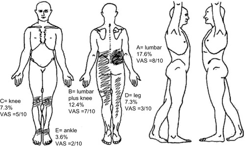 Figure 1 This figure presents a typical body map, with the location of pain sites ordered by importance (not always pain severity) according to the patients, from A to E, pain frequency and intensity in the visual analog scale (VAS).