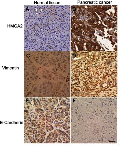 Figure 1 Immunohistochemical staining of HMGA2, E-cadherin and vimentin in normal pancreatic tissue and pancreatic cancer samples. (A) No expression of HMGA2 in the normal pancreatic tissue. (B) Positive signals of HMGA2 in pancreatic cancer. (C) No expression of vimentin in the normal pancreatic tissue. (D) Positive signals of vimentin in pancreatic cancer. (E) Positive signals of E-cadherin in the normal pancreatic tissue. (F): No expression of E-cadherin in pancreatic cancer. Scale bar=50 um.