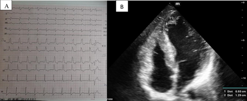 Figure 1 (A) Electrocardiogram (ECG) with complete right bundle branch block (RBBB). (B) Echocardiogram showing apical thrombus 0.93×1.29cm.