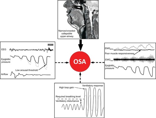 Figure 1 Schematic of the anatomical and non-anatomical causes of OSA.