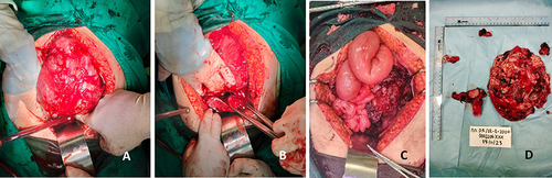 Figure 4 Intraoperative pictures. (A) Left ovarian mass; (B) Mass with uterus and right adnexa; (C) Ileum dilatation due to mass compression; (D) Mass after it was takien out, with estimated size of 20 x 15 x 15 cm, showing the uterus, right adnexa, peritoneal sampling, and omental sampling.