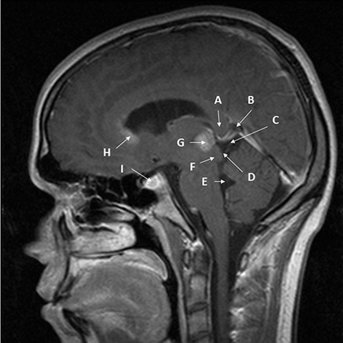 Figure 1 Nearly midline sagittal T1 MRI with gadolinium of pineal region germinoma in a 20-year-old male patient. The patient had signs and symptoms of double vision, light-near dissociation, and decreased upgaze. Cerebrospinal fluid had no markers of germinoma. Diagnosis was made with surgical resection via a infratentorial-supracerebellar approach to minimize risk of uncontrollable hemorrhage given the small size of bulky disease and proximity to major venous structures. (A) – splenium of corpus callosum; (B) – Vein of Galen; (C) – quadrigeminal cistern; (D) – inferior and superior colliculi; (E) – 4th ventricle; (F) – cerebral aqueduct (nearly collapsed); (G) – pineal germinoma, homogenously enhancing; (H) – subependymal spread of germinoma enhancing into mildly enlarged lateral ventricle; (I) – small sellar component of germinoma enhancing.