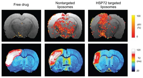 Figure 6 Theranostic activity of an agent that targets the peri-infarct region in ischemic animals.Notes: Top row: T1 magnetic resonance images with superimposed colored maps of changes in relaxivity (R1) after intravenous injection of a therapeutic agent (citicoline) in its free state (left), encapsulated in regular liposomes (center), and in heat shock protein (HSP) 72-targeted liposomes (right). Localization of the liposomes is possible because of their load of gadolinium, a contrast agent that increases R1 relaxivity. Bottom row: pseudocolored magnetic resonance maps of transverse relaxation times (T2) in the same animals 7 days after treatment. The severity of the lesion is clearly reduced by targeted treatment. (Experiments performed in and magnetic resonance image obtained at our laboratories in Santiago de Compostela).
