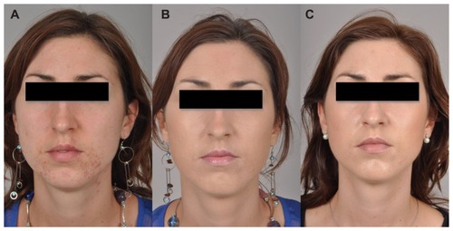 Figure 1 A patient with inflammatory acne at the initial consultation (Vi) before (A) and after makeup performed with the help of the medical cosmetician (B) and at the final visit (Vf) (C).