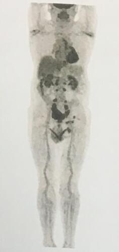 Figure 2 PET-CT results showing multiple hypermetabolic lymph nodes considered metastatic within paravertebral, retroperitoneal, bilateral iliac vessels, bilateral pelvic wall, left inguinal area and medial tubercle of the left paravertebral erector muscle.